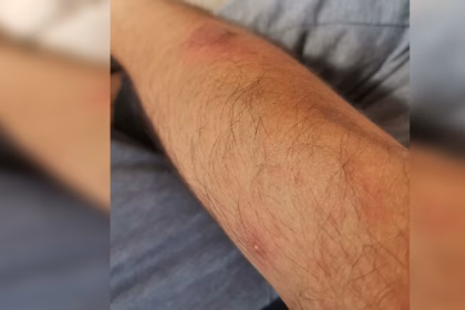 Primera muerte por Mpox en Jalisco confirmada por Salud