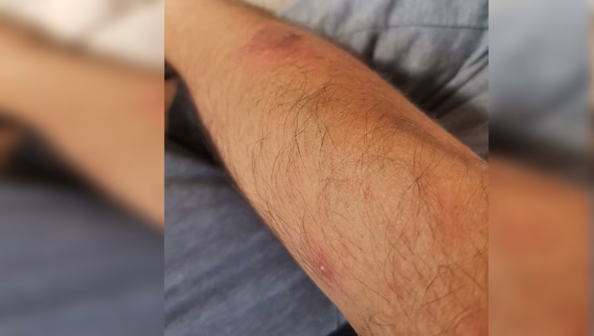 Primera muerte por Mpox en Jalisco confirmada por Salud