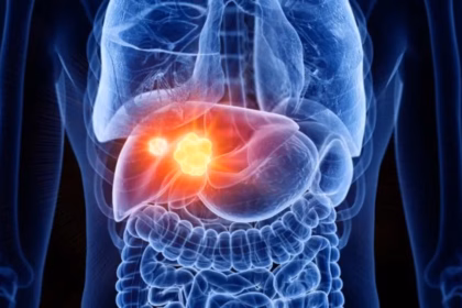 Aumento de casos de cáncer de hígado se duplicará en 2050