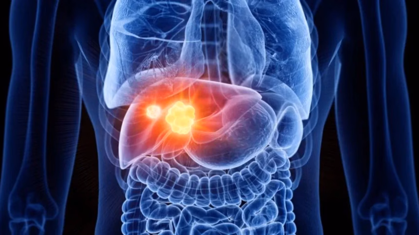 Aumento de casos de cáncer de hígado se duplicará en 2050