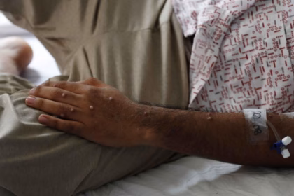 Confirman en Chiapas un caso de viruela del mono bajo vigilancia epidemiológica