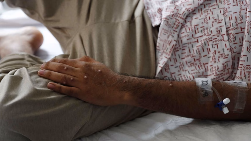Confirman en Chiapas un caso de viruela del mono bajo vigilancia epidemiológica