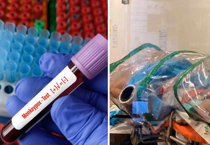 Mpox en Quintana Roo: síntomas, transmisión y casos recientes